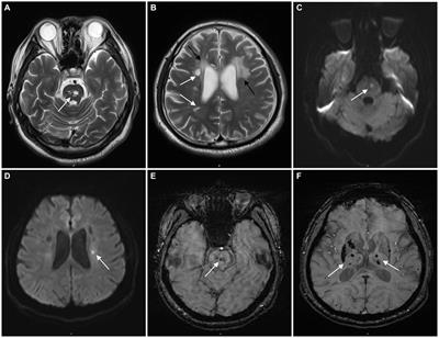 Case report: Recurrent pontine stroke and leukoencephalopathy in a patient with de novo mutation in COL4A1